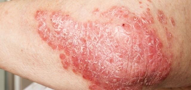 Qu'est ce que l'eczema ?